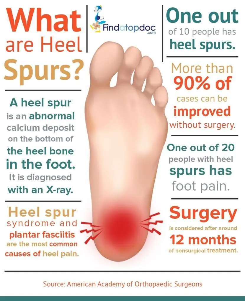 Heel spur &#8211; causes, symptoms, diagnosis, treatment. What is a heel spur?