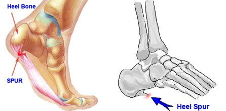 Heel spur &#8211; definition, causes, symptoms, treatment, prevention