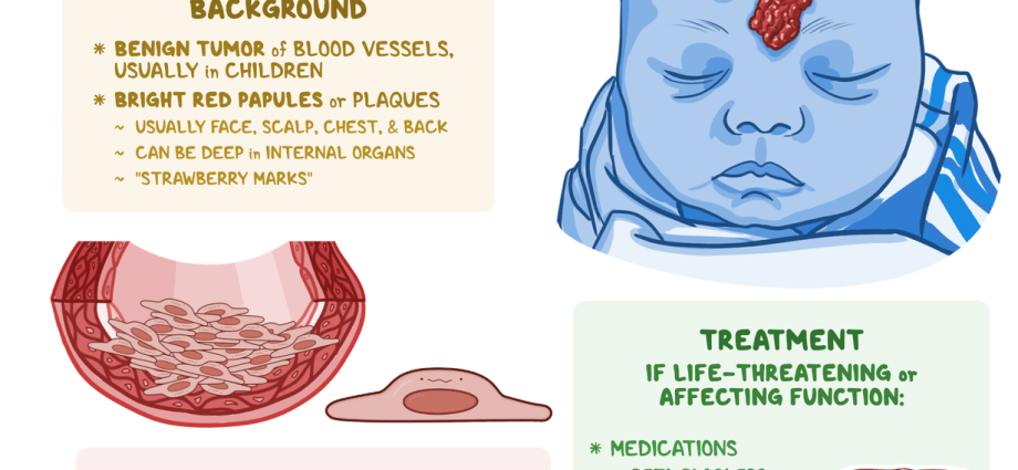 Hemangiomas &#8211; causes, types, symptoms, treatment. How to recognize hemangiomas? WE EXPLAIN