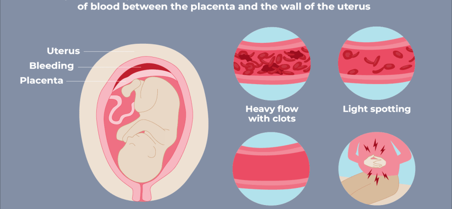 Hematoma in pregnancy &#8211; is it dangerous? What is the treatment like?