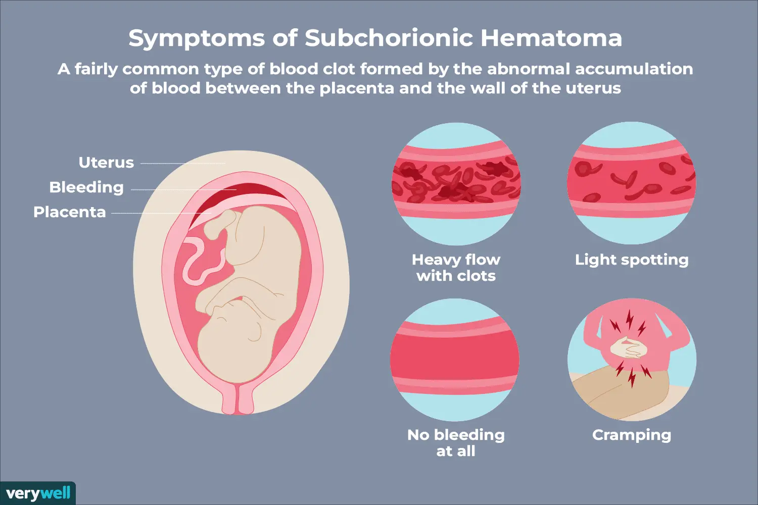 Hematoma in pregnancy &#8211; is it dangerous? What is the treatment like?