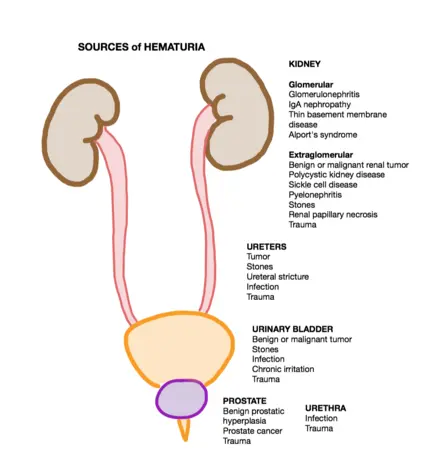 Hematuria &#8211; causes. What is hematuria?