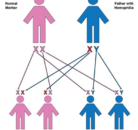 Hemophilia &#8211; who gets it and why?