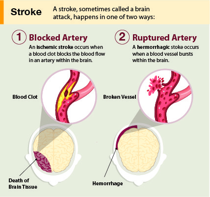 Hemorrhagic stroke &#8211; symptoms, causes, prognosis