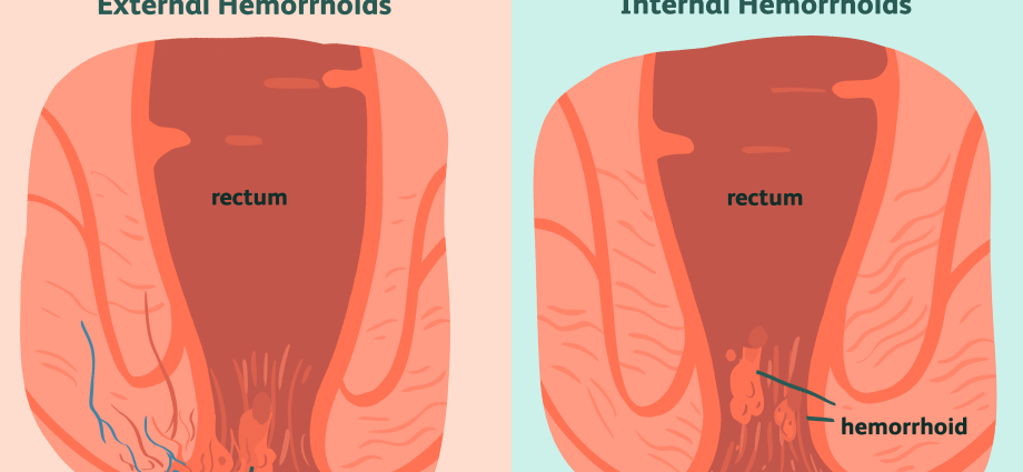 Hemorrhoids are more than an embarrassing problem. Why is it better not to underestimate them?