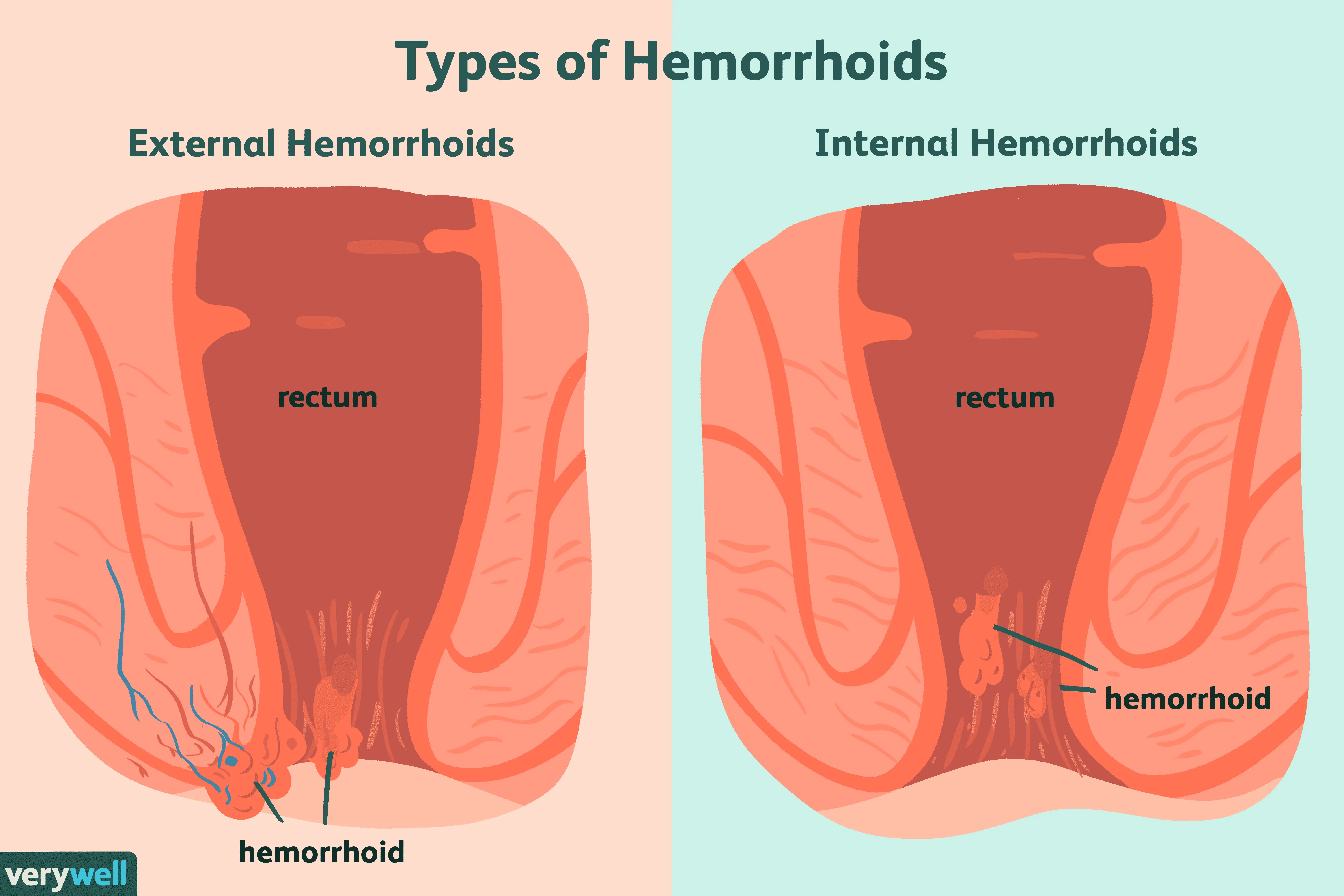 Hemorrhoids are more than an embarrassing problem. Why is it better not to underestimate them?