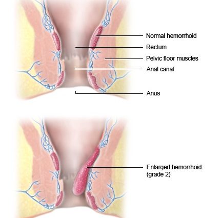 Hemorrhoids &#8211; is it taboo?