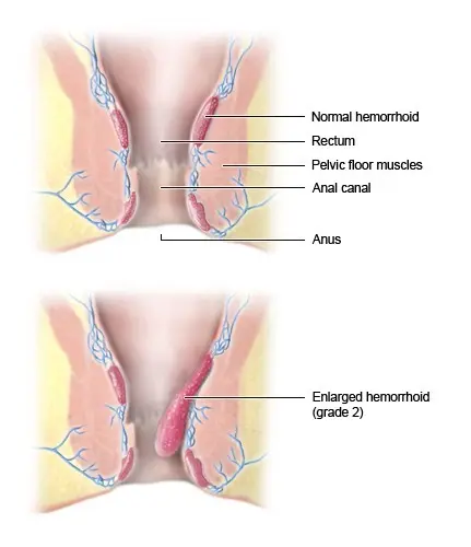 Hemorrhoids &#8211; is it taboo?