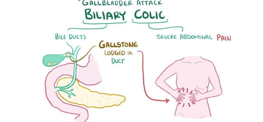 Hepatic (biliary) colic