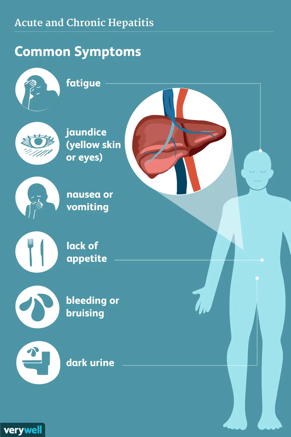 Hepatitis C &#8211; symptoms and treatment of hepatitis C