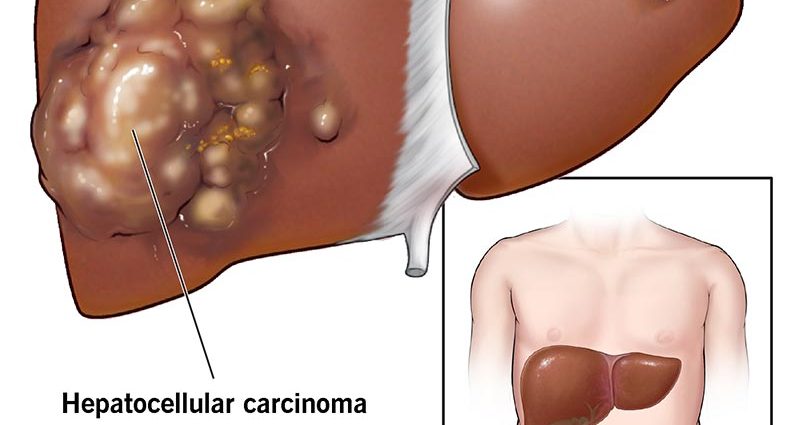 Hepatocellular carcinoma &#8211; causes, symptoms, treatment