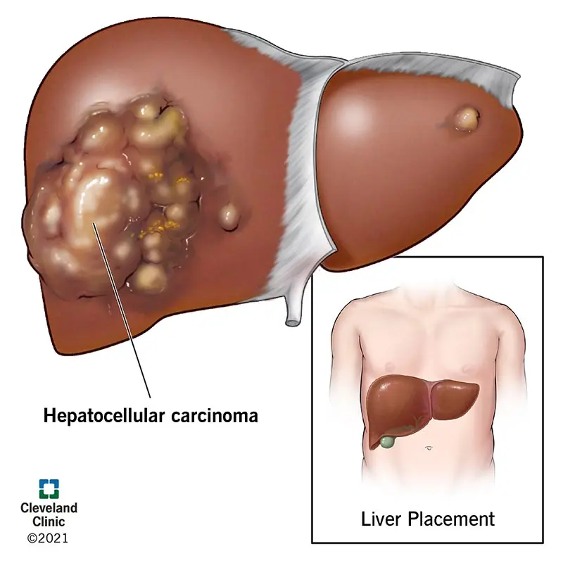 Hepatocellular carcinoma &#8211; causes, symptoms, treatment