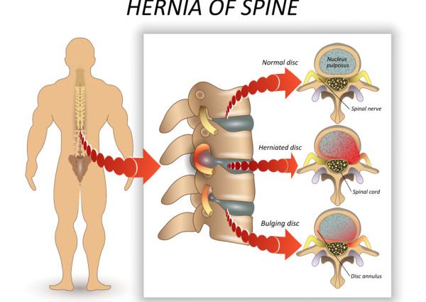 Hernia of the spine &#8211; symptoms and causes. How to cure a spinal hernia?