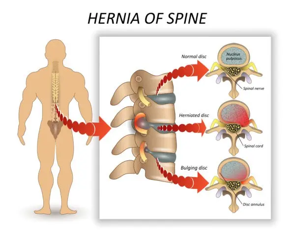 Hernia of the spine &#8211; symptoms and causes. How to cure a spinal hernia?