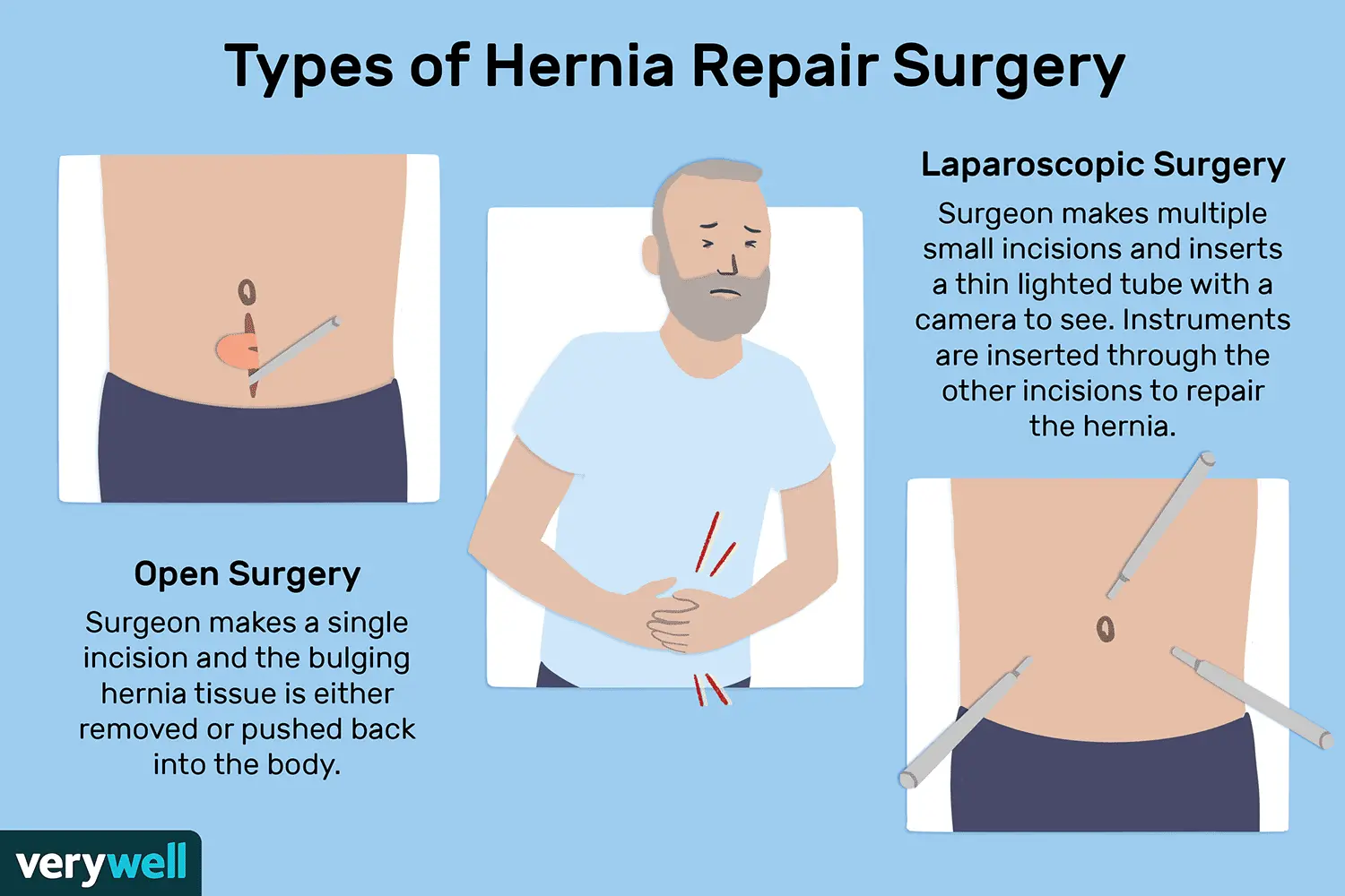 Hernia &#8211; surgery. How is a hernia treated?