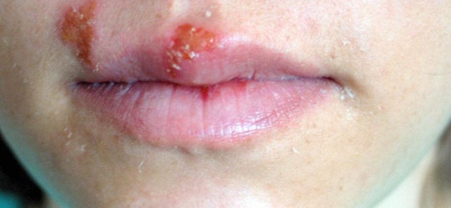 Herpes &#8211; causes, prevention and treatment. What can be confused with herpes?