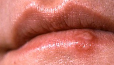 Herpes in children &#8211; causes, symptoms