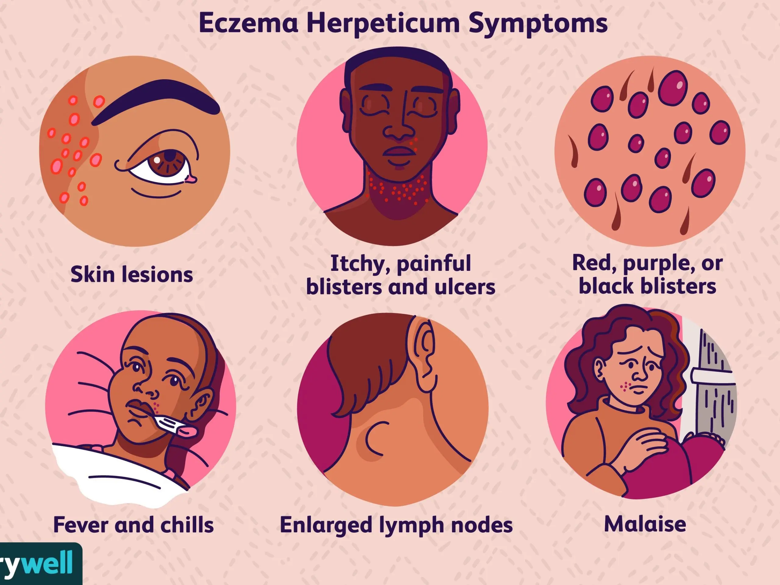 Herpetic eczema &#8211; symptoms and treatment