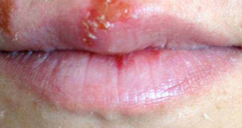 Herpex for skin infections caused by the herpes virus. How to use?