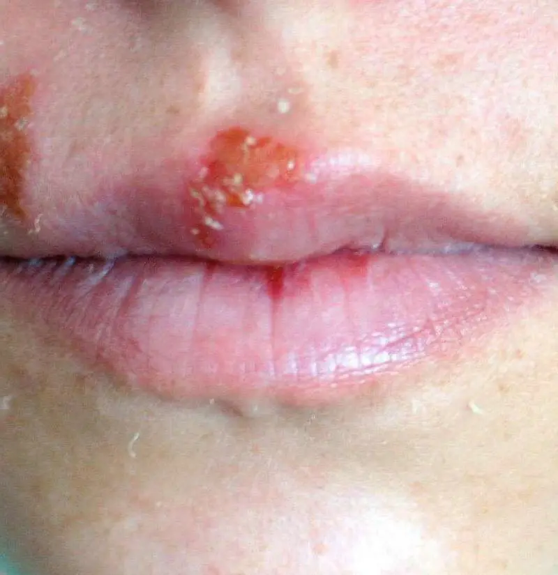 Herpex for skin infections caused by the herpes virus. How to use?