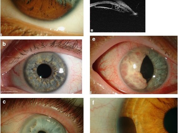 Heterochromia, or irides of various colors in the eye &#8211; causes, treatment. A rare defect of the iris