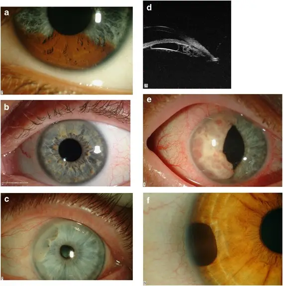 Heterochromia, or irides of various colors in the eye &#8211; causes, treatment. A rare defect of the iris