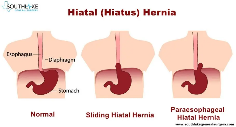 Hiatal hernia &#8211; what is it, symptoms, causes, types. How to treat and minimize symptoms?