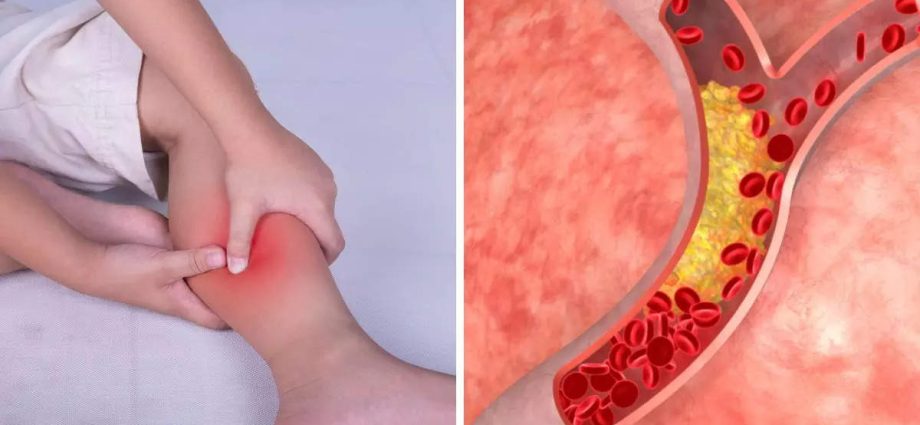 ہائی کولیسٹرول کی علامات جو آپ اپنی ٹانگوں پر محسوس کر سکتے ہیں۔ اسے کم نہ سمجھیں، یہ پیڈ ہو سکتا ہے!