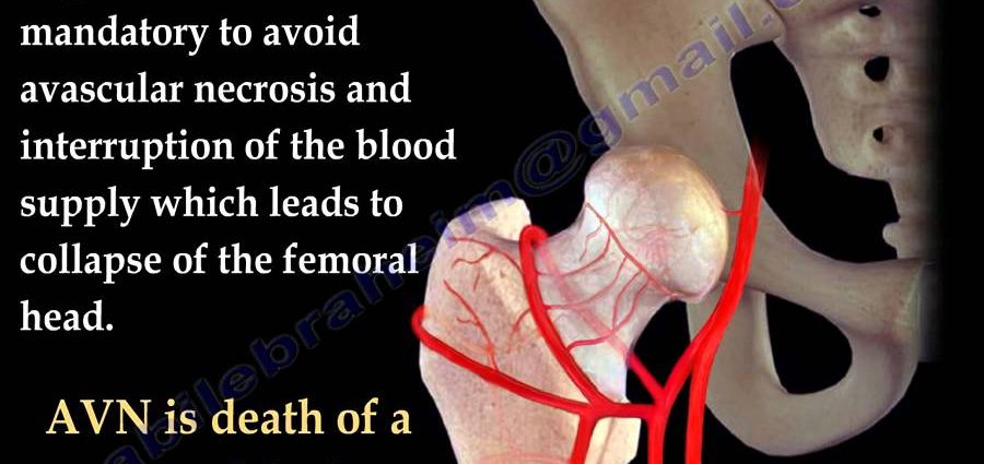 Hip dislocation &#8211; what is the treatment?