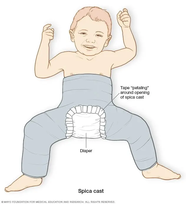 Hip dysplasia &#8211; diagnosis and treatment