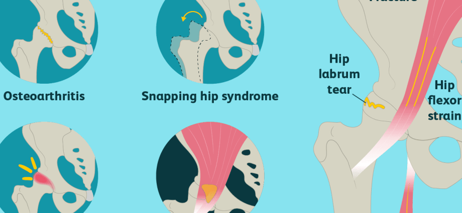 Hip joint &#8211; are the first signs of pain a cause for concern? The causes of hip pain?