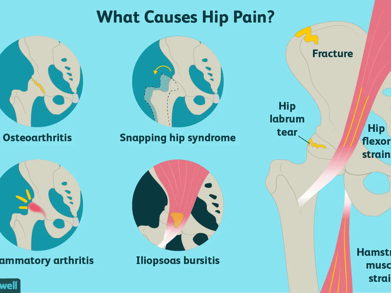 Hip joint &#8211; are the first signs of pain a cause for concern? The causes of hip pain?