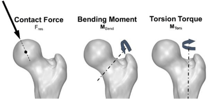 Hip joint prosthesis for XXXL patients