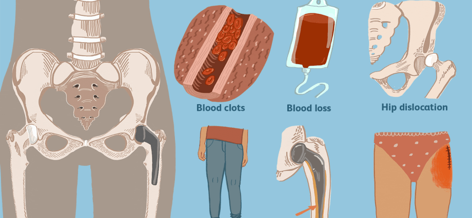 hip-operations-indications-course-rehabilitation-how-much-does-hip