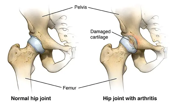 Hip &#8211; structure, functions, operation. Hip diseases and their treatment