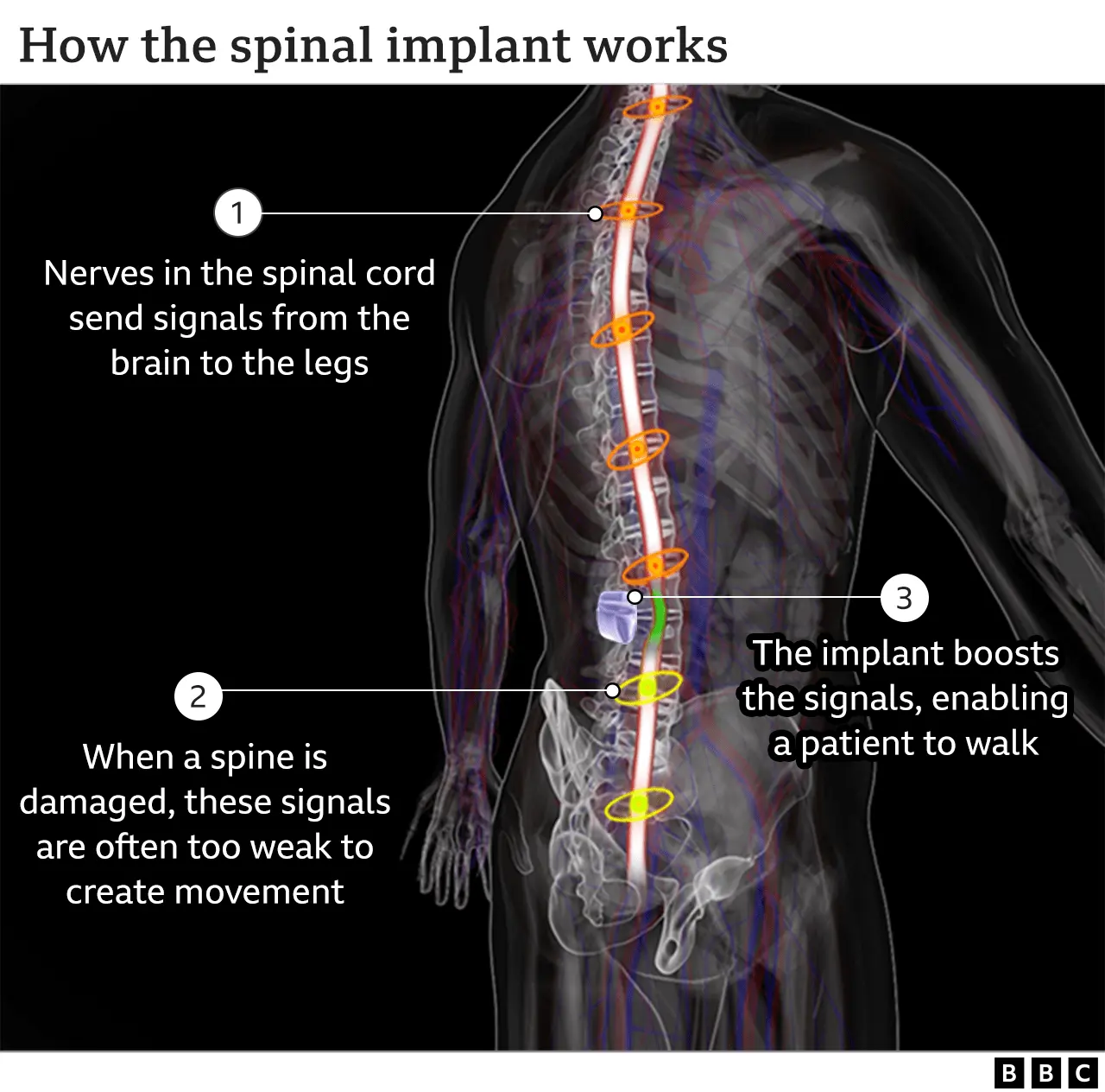 His core was severed and he was paralyzed from the waist down. After an innovative operation, she begins to walk