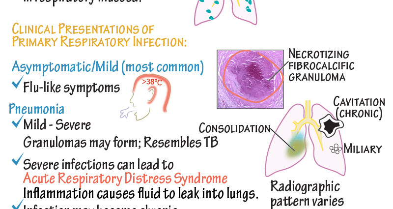 Histoplasmosis &#8211; symptoms and treatment of mycosis of the reticuloendothelial system