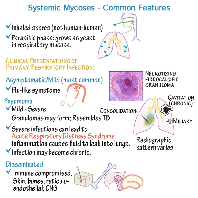 Histoplasmosis &#8211; symptoms and treatment of mycosis of the reticuloendothelial system