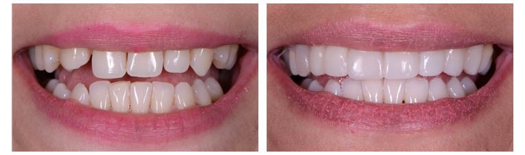 Hollywood smile, or about aesthetic dentistry