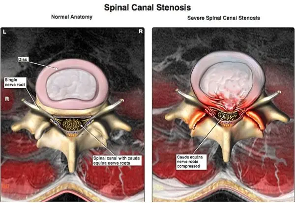 Horse tail syndrome &#8211; where it comes from, consequences