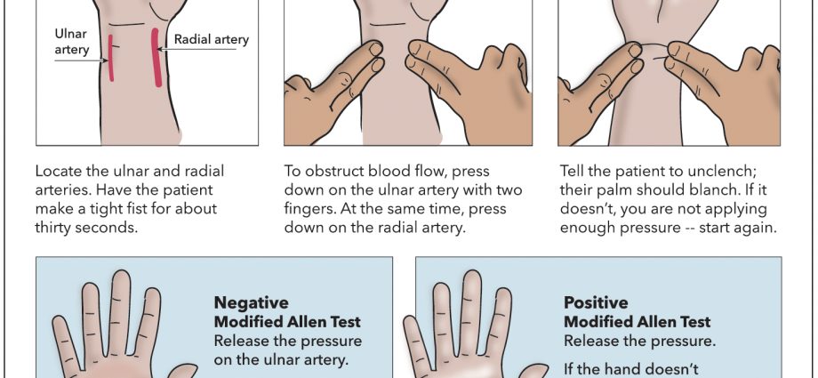 How can you tell if your arteries are patent? Do the Allen test