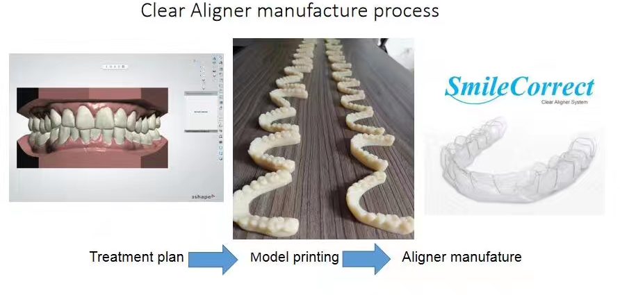 How do Clear Aligner braces work?