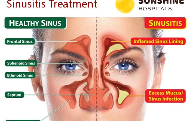 How do you cure chronic sinusitis?