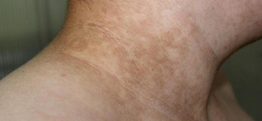 How do you know when you are one step away from diabetes? One of the marks appears on the skin