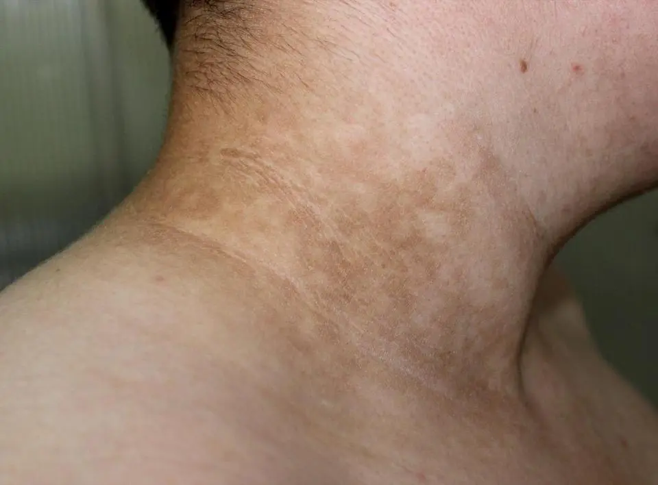 How do you know when you are one step away from diabetes? One of the marks appears on the skin