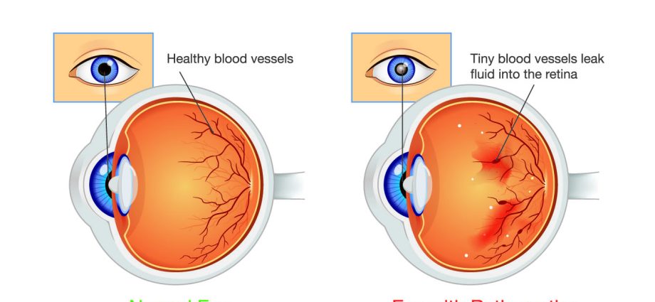 How Does Diabetes Damage Your Eyesight? This is one of the most common causes of blindness in our society [EXPLAINED]