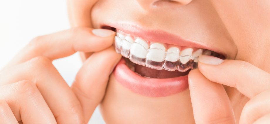 How does Invisalign braces work?