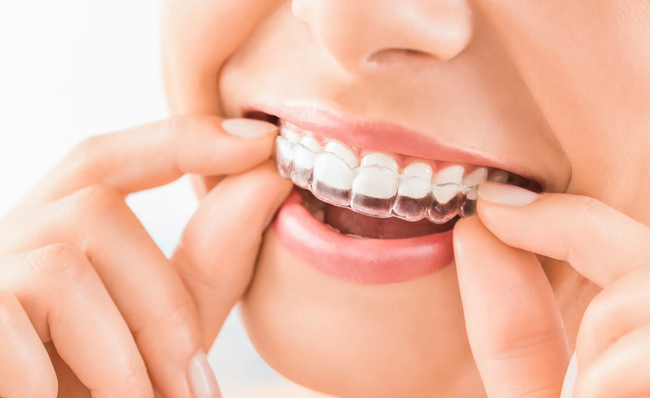 How does Invisalign braces work?