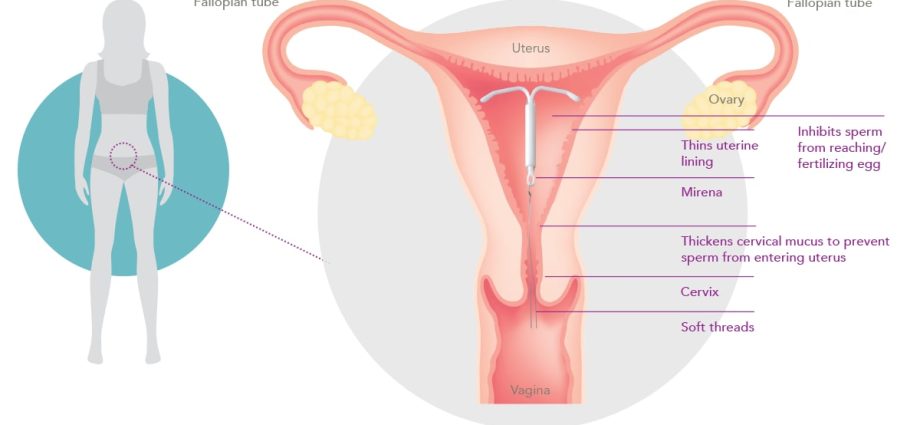 How does Mirena work? About the hormonal IUD