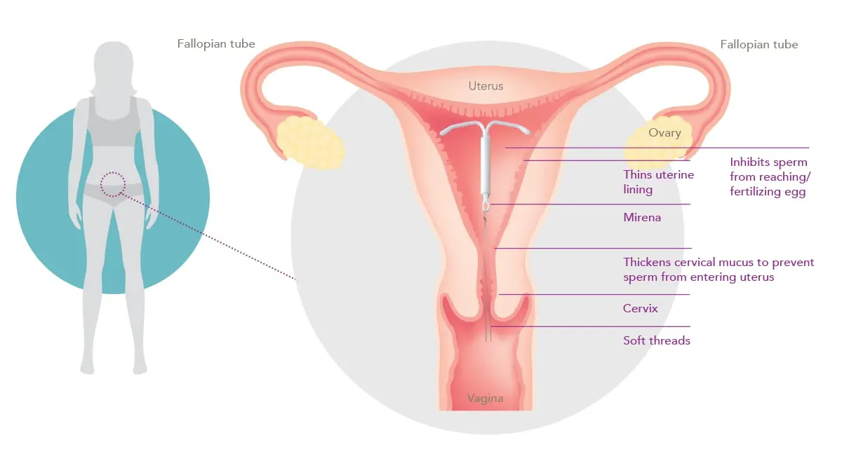 How does Mirena work? About the hormonal IUD